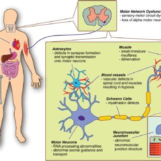 (PDF) Emerging Therapies and Challenges in Spinal Muscular Atrophy