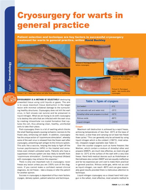 Cryosurgery for warts in general practice