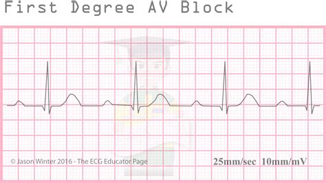 First Degree Av Block Ekg Strip