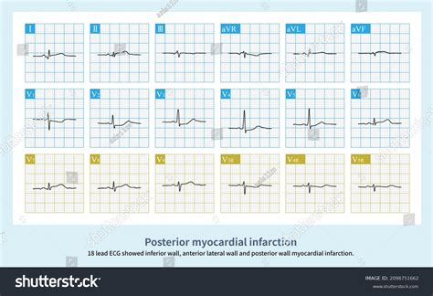 Posterior Segment Images: Browse 186 Stock Photos & Vectors Free ...