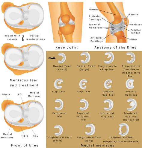 The Three Most Common Symptoms of Knee Meniscal Tears