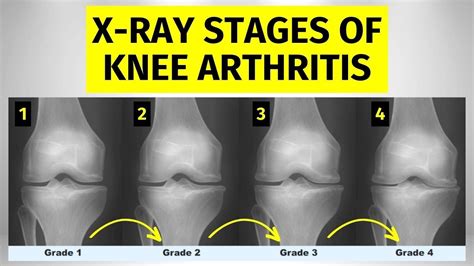 X-ray Stages Of Knee Arthritis