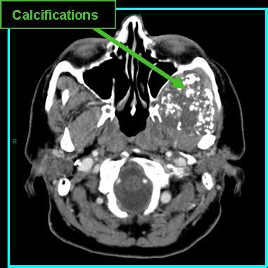 Chondrosarcoma - Radiology | Iowa Head and Neck Protocols