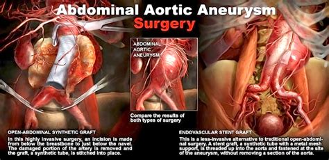 Treatment of Aortic Aneurysm - StoryMD