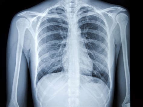 Chest X-Ray for the Diagnosis of Lung Cancer