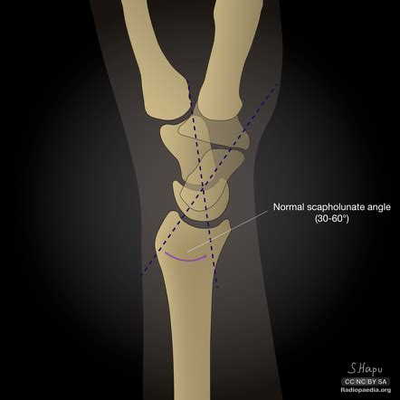 Scapholunate angle | Radiology Reference Article | Radiopaedia.org