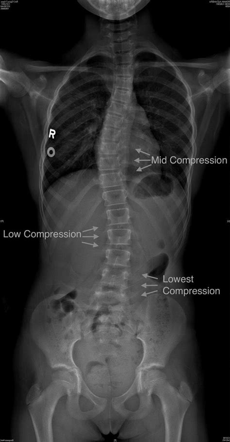 Read and Interpret X-ray and Radiologist’s Report for Scoliosis — Lyons ...