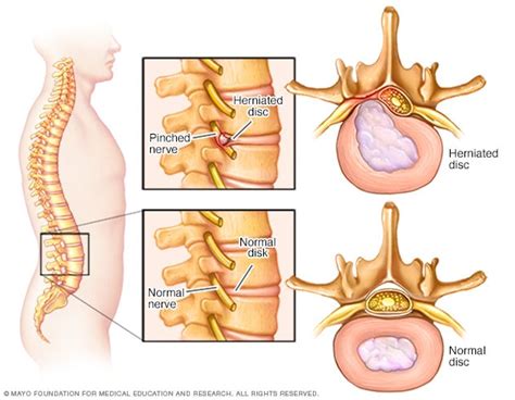 Pinched nerve - Symptoms and causes - Mayo Clinic