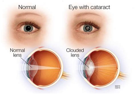 Babies can have cataracts too, ensure regular eye check-up from birth ...