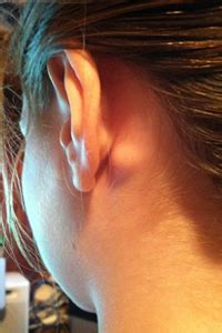 Lump Behind Ear: Pictures, Cyst Behind Ear Causes & Treatment