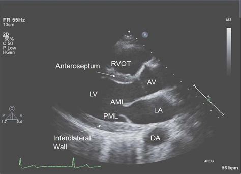 Echocardiogram, Transesophageal, Transthoracic, Stress Echocardiogram