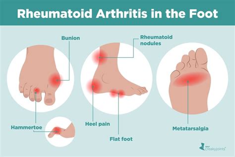 Rheumatoid Arthritis in the Feet: Symptoms and Treatments