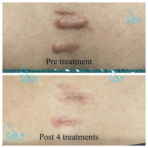 Keloid Scar Treatment / Removal London & Surrey | Dr H Consult