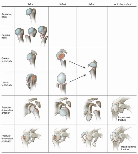 Intramedullary Fixation of Proximal Humerus Fractures | Musculoskeletal Key