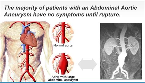 Abdominal Aortic Aneurysms | Prevention