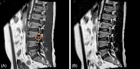 Lumbar Spine Mri Labeled