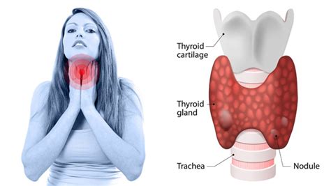 Best Thyroid Removal Surgery hospital | Thyroid Cancer Treatment ...