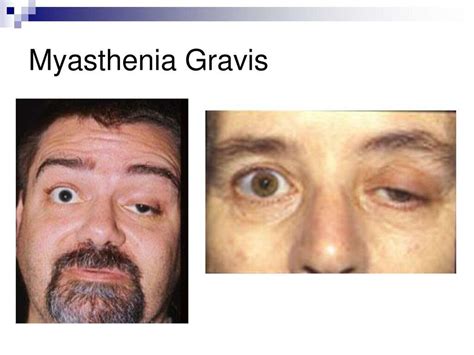 Myasthenia Gravis Symptoms