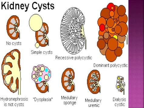 Cystic kidney diseases