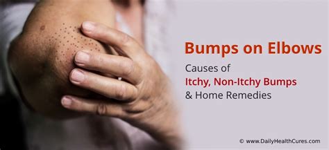 Cluster Of Bumps On Elbow Images, Photos | Mungfali