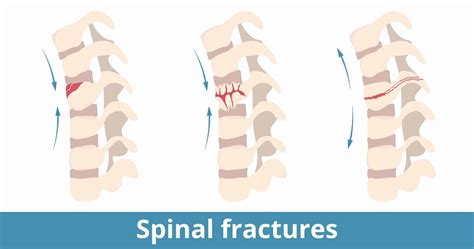 Spinal Fractures: Types, Causes, Symptoms, Diagnosis, and Treatments ...