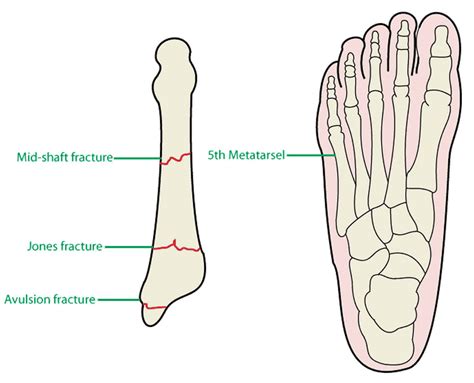 Metatarsal stress fracture causes, symptoms, diagnosis, treatment ...