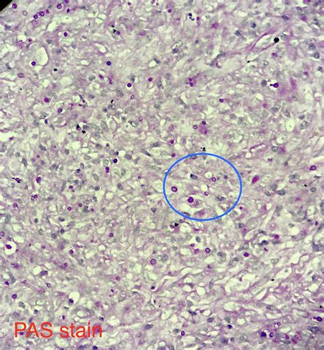 Soap Bubble Lesions Cryptococcus Neoformans In Brain