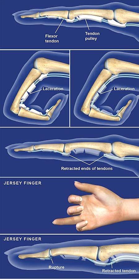 Flexor Tendon Injuries | Central Coast Orthopedic Medical Group