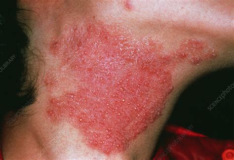 Fungal skin infection - Stock Image - M270/0208 - Science Photo Library