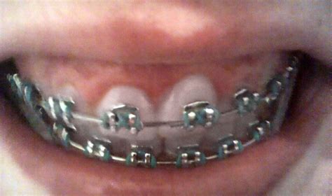 Maria's Blog: Braces Elastics Picture Update - 14/04/2012