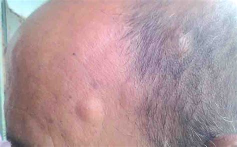 Lipoma On Top Of Head