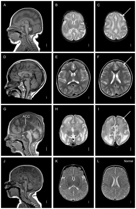 Lissencephaly Radiology