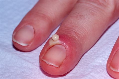 What Causes White Spots On Nail Beds at Tessa Jennings blog