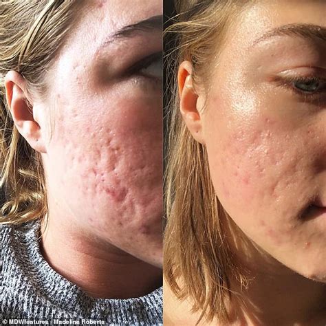 Woman with cystic acne feared she was 'unlovable' due to scarred skin ...