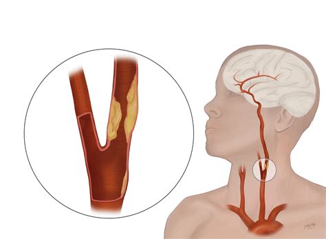 Carotid Artery Disease/Stroke - CTVSA of Jacksonville, FL