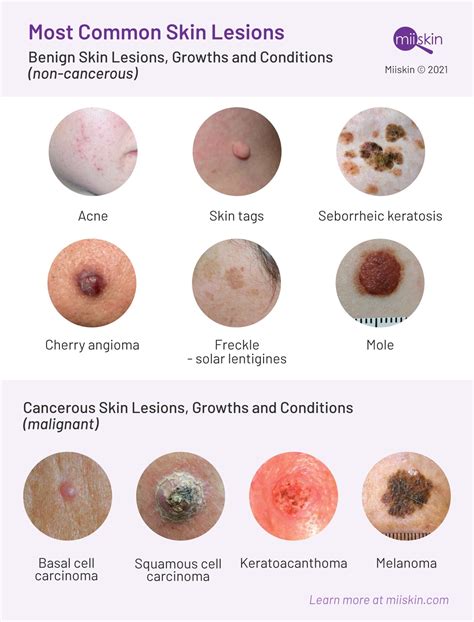 Types Of Skin Cancer Diagram