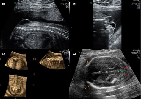 Spina Bifida Ultrasound