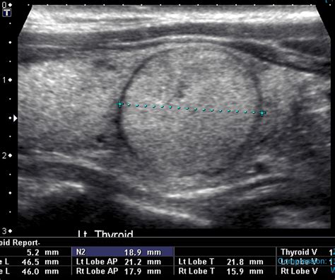 To biopsy or not -the thyroid nodule dilemna - Dr Iain Duncan