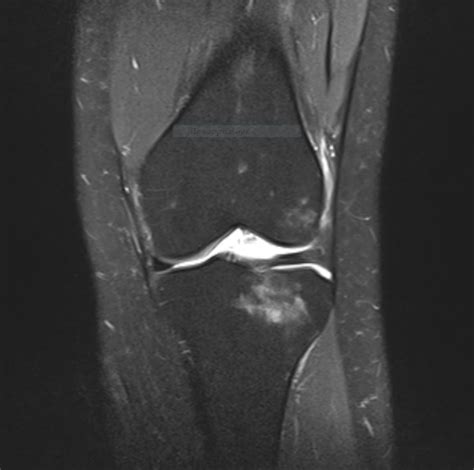 Strange bone marrow edema · MSK Radiology School