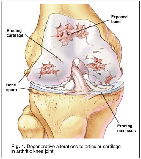 Degenerative Meniscus Tear - Carolinas Pain Center - Chronic Conditions