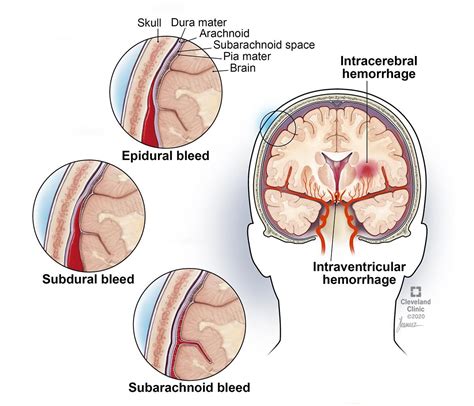 Epidural Hematoma (EDH): Symptoms, Causes & Treatment