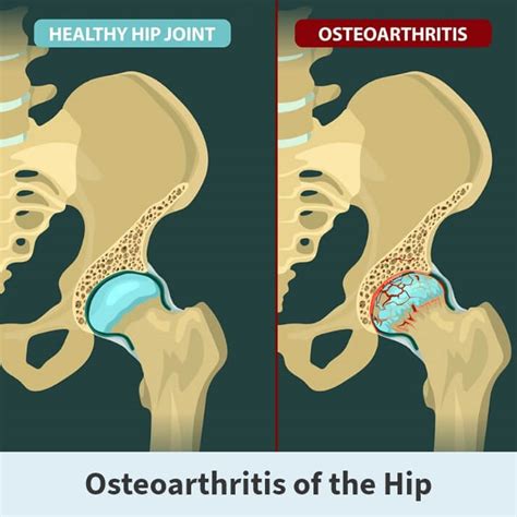 Osteoarthritis of the Hip | Florida Orthopaedic Institute