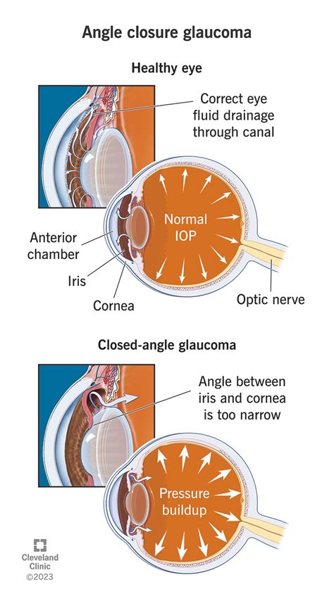 Angle-Closure Glaucoma: Symptoms & Treatment