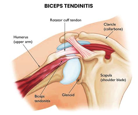 Biceps Tendinopathy - NJ's Top Orthopedic Spine & Pain Management Center