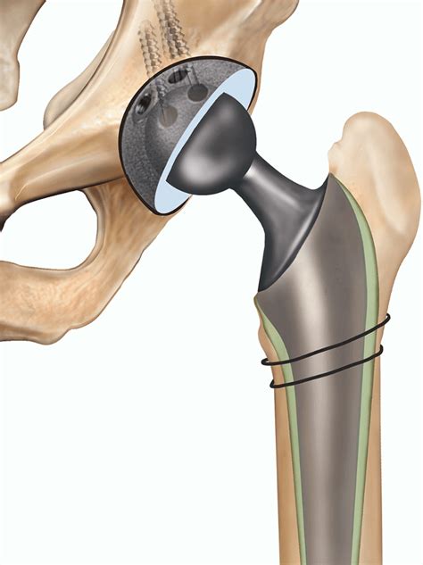 Surgery Hip Replacement