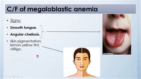 Megaloblastic Anemia Symptoms