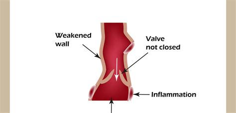 Venous Leg Ulcers: Causes and Symptoms - The Vein Center of Maryland