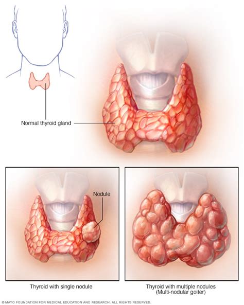 Goiter - Symptoms and causes - Mayo Clinic