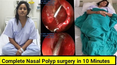 Nasal polyp surgery | sinus surgery | complete surgery procedure 10 ...