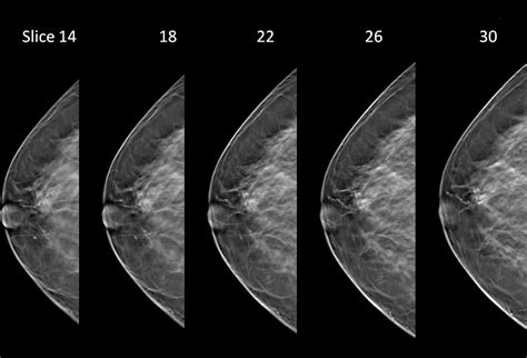 Mammogram Shows Abnormality